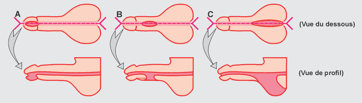 Descente testiculaire